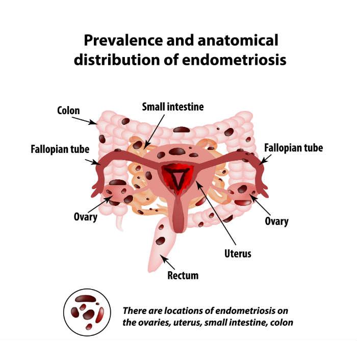 endometriosis symptoms