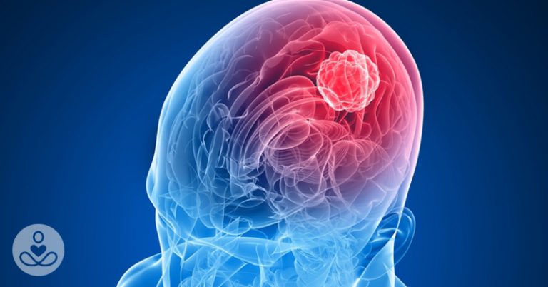 7 Most Common Signs of a Brain Tumor - Featured image