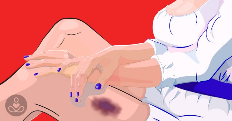8 Reasons You May Be Bruising Easily - Featured image