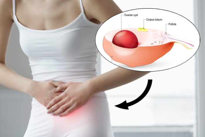 dermoid cyst ovary period pain