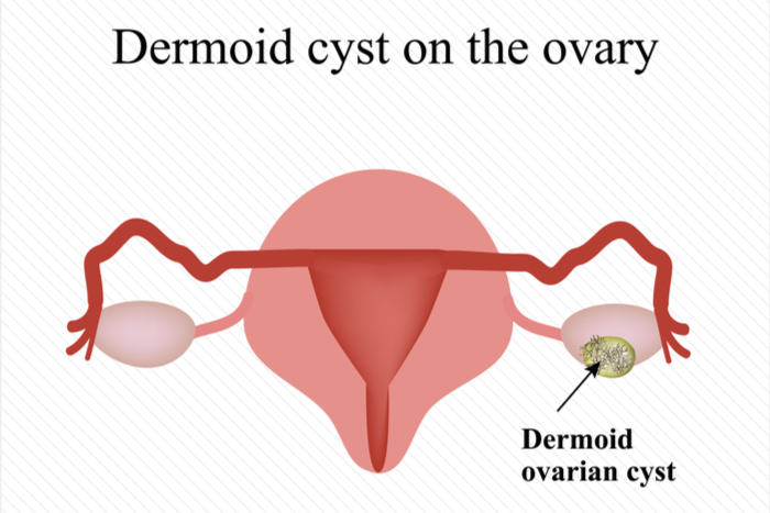 dermoid cyst ovary