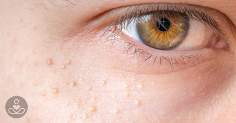 If You Have These Tiny, White Bumps on Your Face, Don’t Try to Remove Them! - Featured image