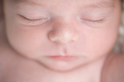 milia removal