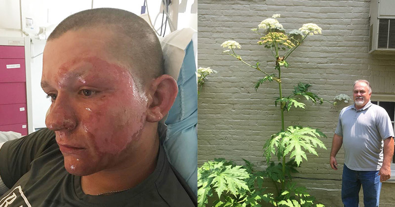 Teen Spends 2 Nights in Burn Unit After Run-In With Giant Hogweed Plant