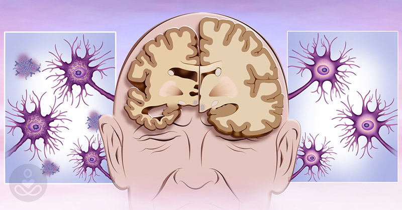 Do You Have ‘Memory Thief Syndrome’? The Link Between Dementia and Hearing Loss