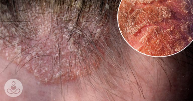 Scalp Eczema: 8 Natural Remedies for Red, Flaky, or Itchy Scalps - Featured image