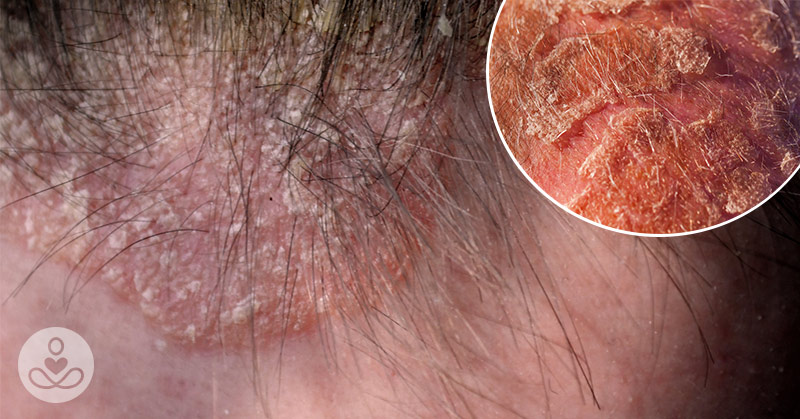 Scalp Eczema: 8 Natural Remedies for Red, Flaky, or Itchy Scalps