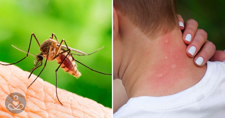Mosquito Bites Sting and Swell? You Could Have Skeeter Syndrome - Featured image