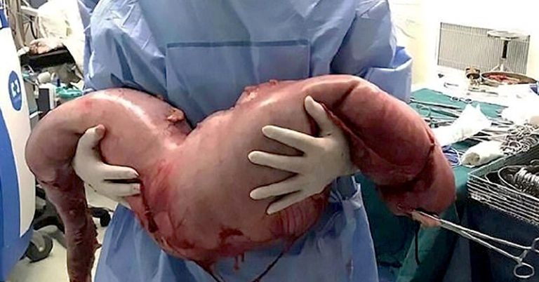 Hirschsprung’s Disease: How One Man Had 30 Lbs of Feces Removed from Colon - Featured image