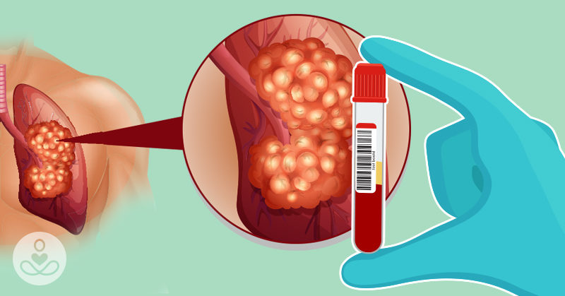 Finally! Blood Test Could Catch Lung Cancer Before It’s Too Late