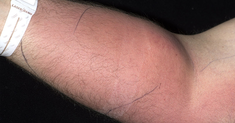 A Man Was Once Hospitalized After Injecting Semen Into His Arm to ‘Cure Back Pain’