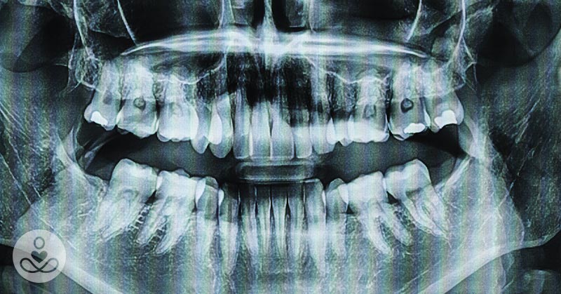 Scientist May Have Discovered a Drug that Fixes Cavities and Regrows Teeth