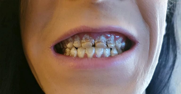 British Student with Extreme Tooth Decay Says Energy Drinks ‘Completely Ruined His Life’ - Featured image