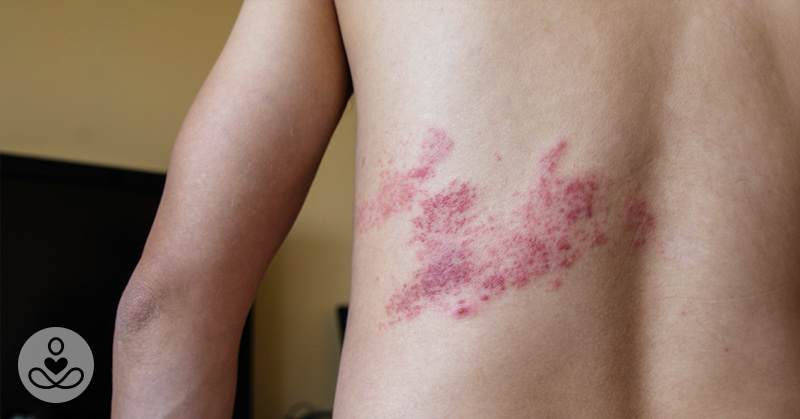 Too Young for Shingles? Not for This 36-year old