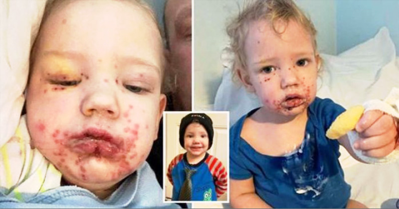 The Deadly Kiss: Toddler Hospitalized After His Face Was Ravaged By Herpes