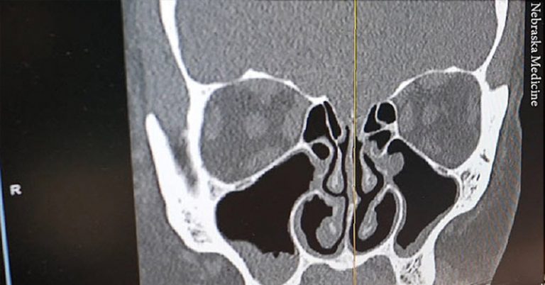 Two And A Half Years Later, Woman’s Chronic Runny Nose Turned out to Be As A Result Of CSF Leak - Featured image