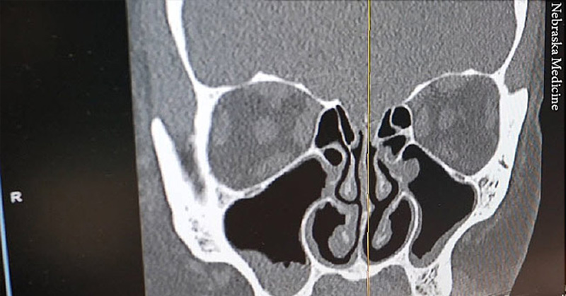 Two And A Half Years Later, Woman’s Chronic Runny Nose Turned out to Be As A Result Of CSF Leak