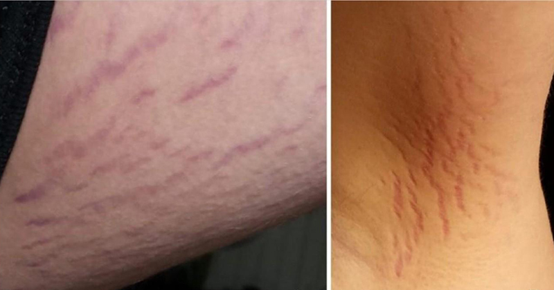 Misdiagnosis: Rare Cat Scratch Disease Was Actually the Cause Of Teen’s Schizophrenia-Like Symptoms, Report Says