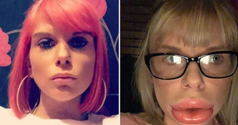Dangers of Lip Fillers: Mother Ends Up in Hospital After At-Home Treatment