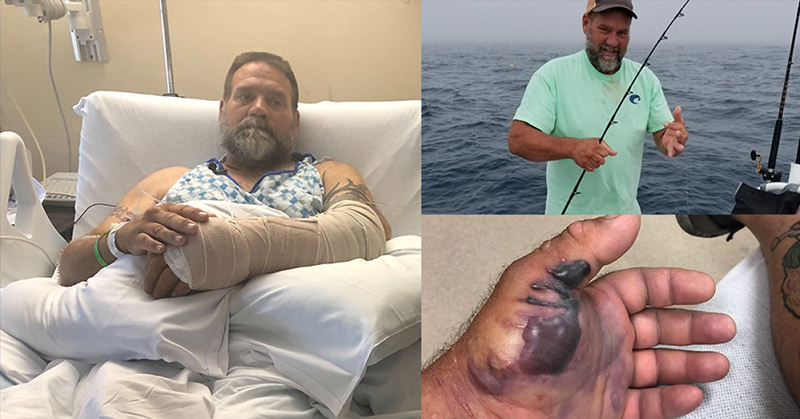 Flesh-Eating Bacteria Infects Florida Man Fishing Off the Coast Of Palm Harbor in the Gulf of Mexico