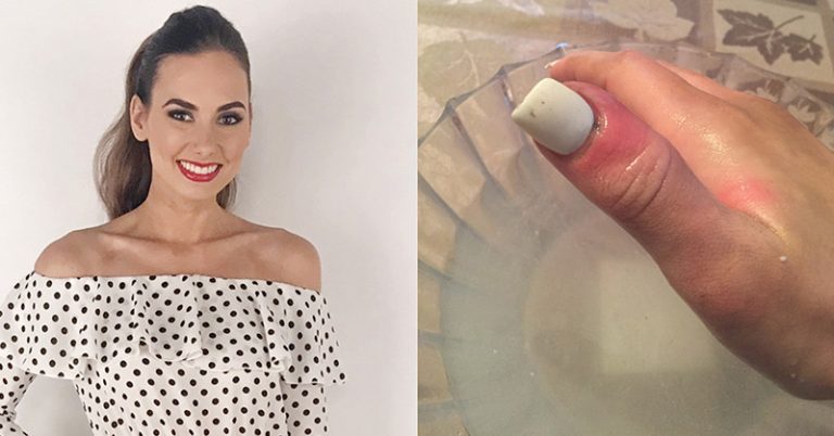 ‘Bruise’ turned out to be deadly melanoma hiding on 21-year-old’s nail - Featured image