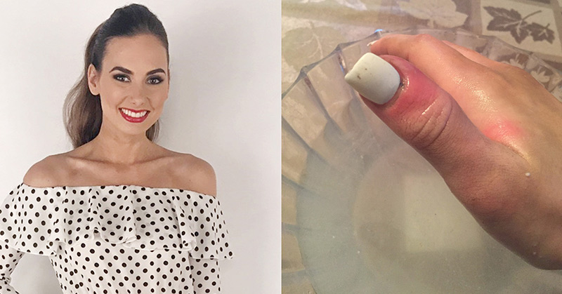 ‘Bruise’ turned out to be deadly melanoma hiding on 21-year-old’s nail