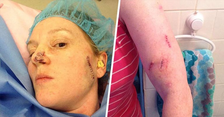 43-Year-Old Tennessee Woman Has Had 86 Skin Cancer Surgeries in the Past 20 Years - Featured image