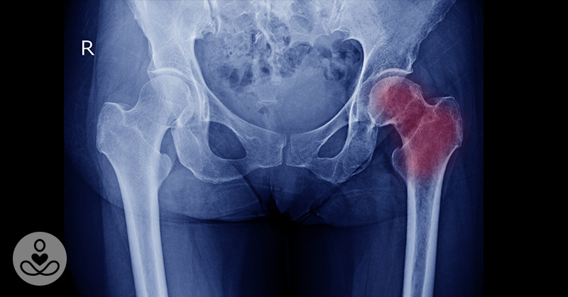 Does High Intake of Vitamins B6 and 12 Increase Hip Fracture Risk?