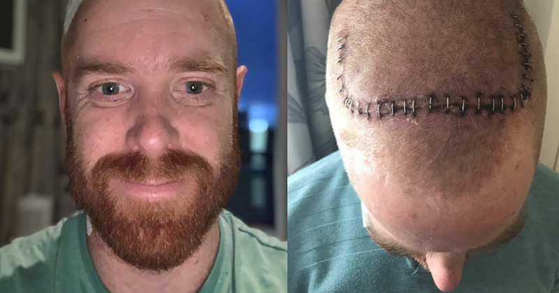 Deep Brain Stimulation: Adelaide Man Receives ‘Pacemaker for the Brain’ To Combat Young Onset Parkinson’s Disease