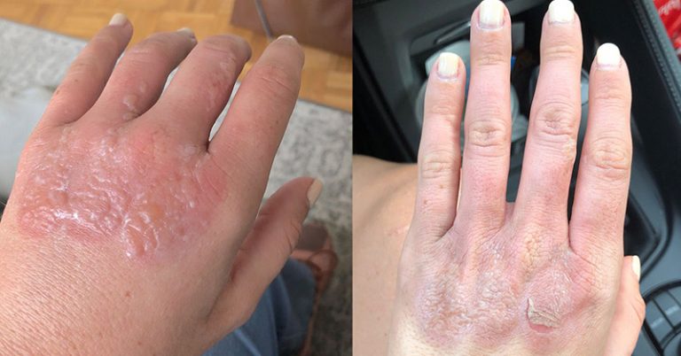 This Woman’s Blistering Burn Shows Why You Should Never Make a Margarita in the Sun - Featured image