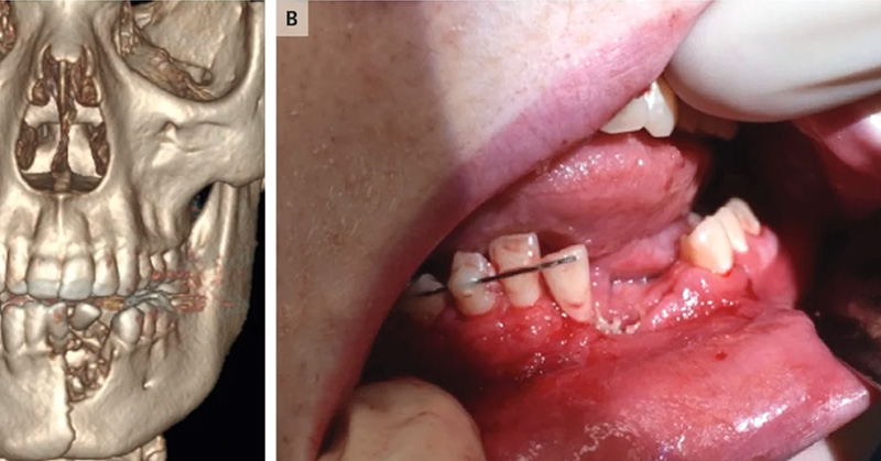 17-year-old Gets His Jaws and Teeth Shattered in a Vape Pen Explosion