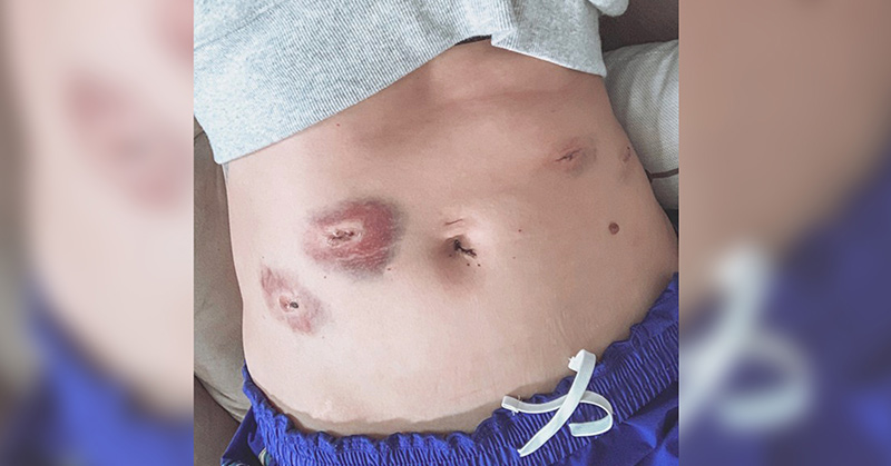 A Face of Endometriosis