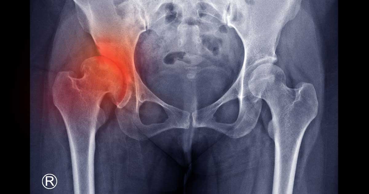 What Happens When You Break a Hip? (and How to Avoid a Hip Fracture)