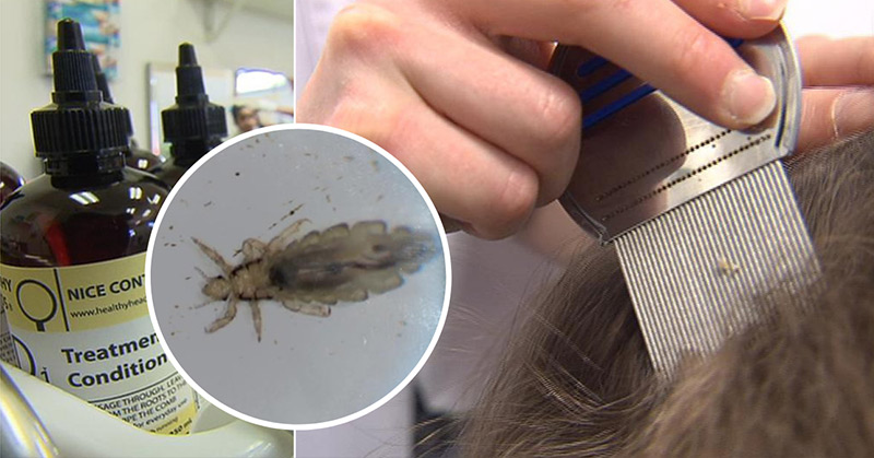 “Super Lice”: Chemical-Resistant Head Lice On the Rise