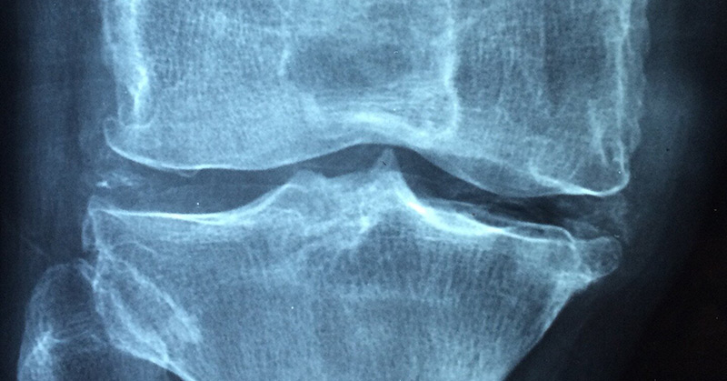 Could Exercise Prevent Arthritis? New Research Is Hopeful