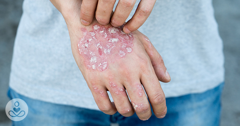 9 Foods That Could Make Eczema Worse (And Many That Can Help)