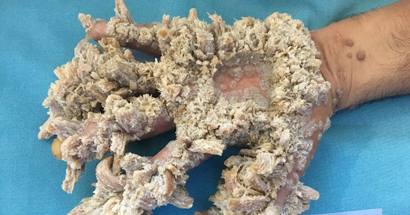 Patient With ‘Tree Man’ Syndrome Says He ‘Can Finally Live A Normal Life’ - Featured image
