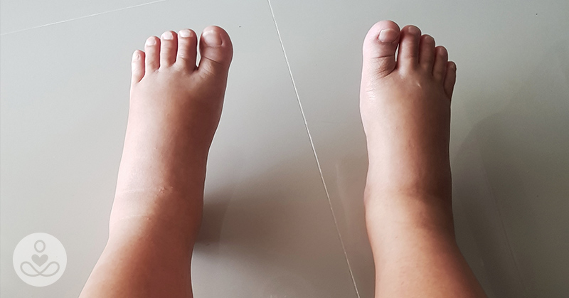 10 Swollen Feet Causes + When To See Your Doctor