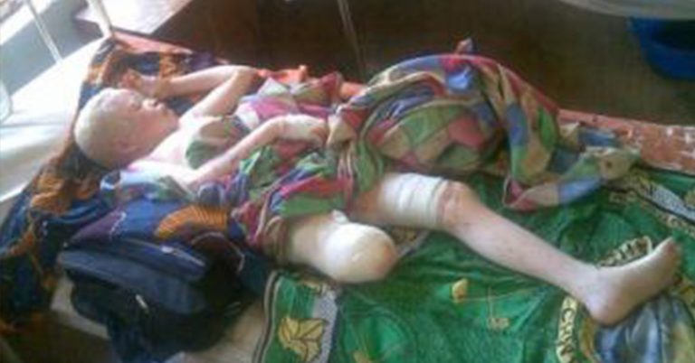 Albinos Hunted in Tanzania and Malawi - Featured image