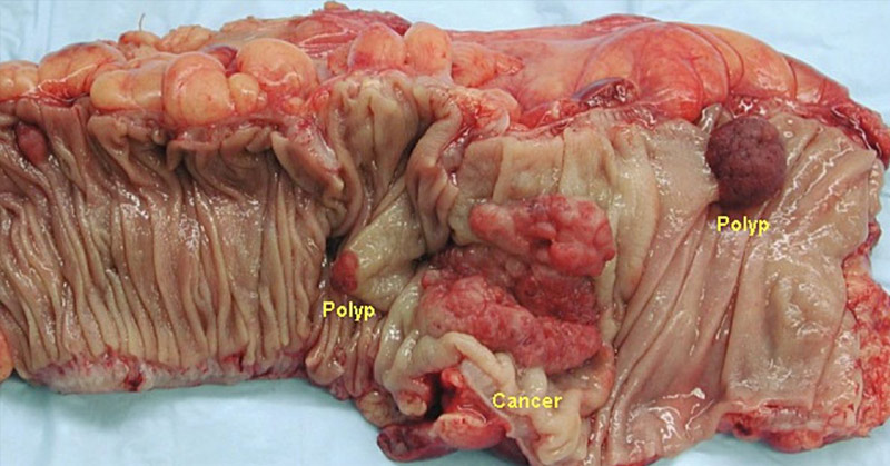 Resistant Starches, Good Bacteria, and Colon Cancer—What You Need to Know