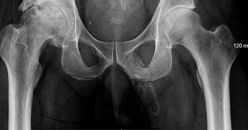 An X-Ray Reveals Bone Forming in Man’s Penis