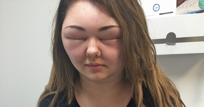 Woman’s Face Swells Three Times Usual Size After Using Organic Hair Dye