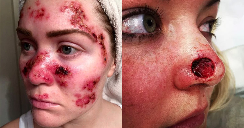 The Danger of Tanning Beds: 4 Women, 4 Cases of Cancer - Featured image