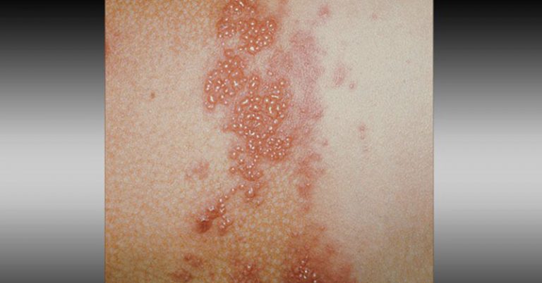 14 Rashes You Need to Know: Common Dermatologic Diagnoses - Featured image