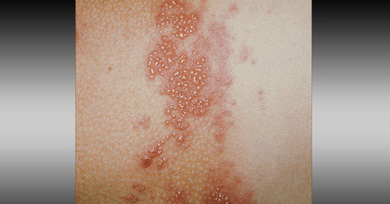 14 Rashes You Need to Know: Common Dermatologic Diagnoses