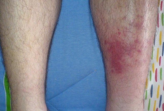 cellulitis