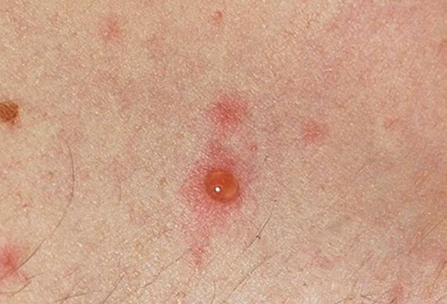 chicken pox