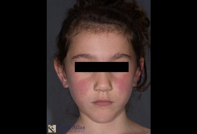 erythema infectiosum