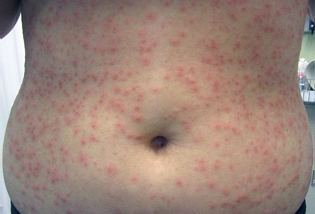 folliculitis