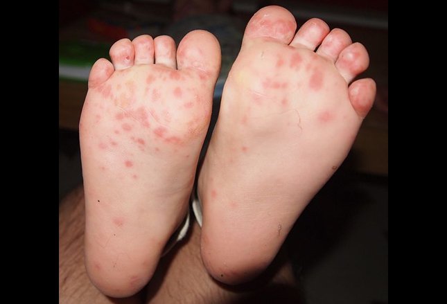 hand foot mouth disease